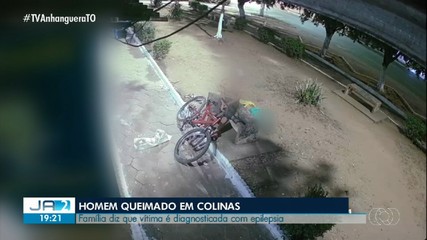 Família diz que vítima de queimadura em Colinas é diagnosticada com epilepsia; entenda