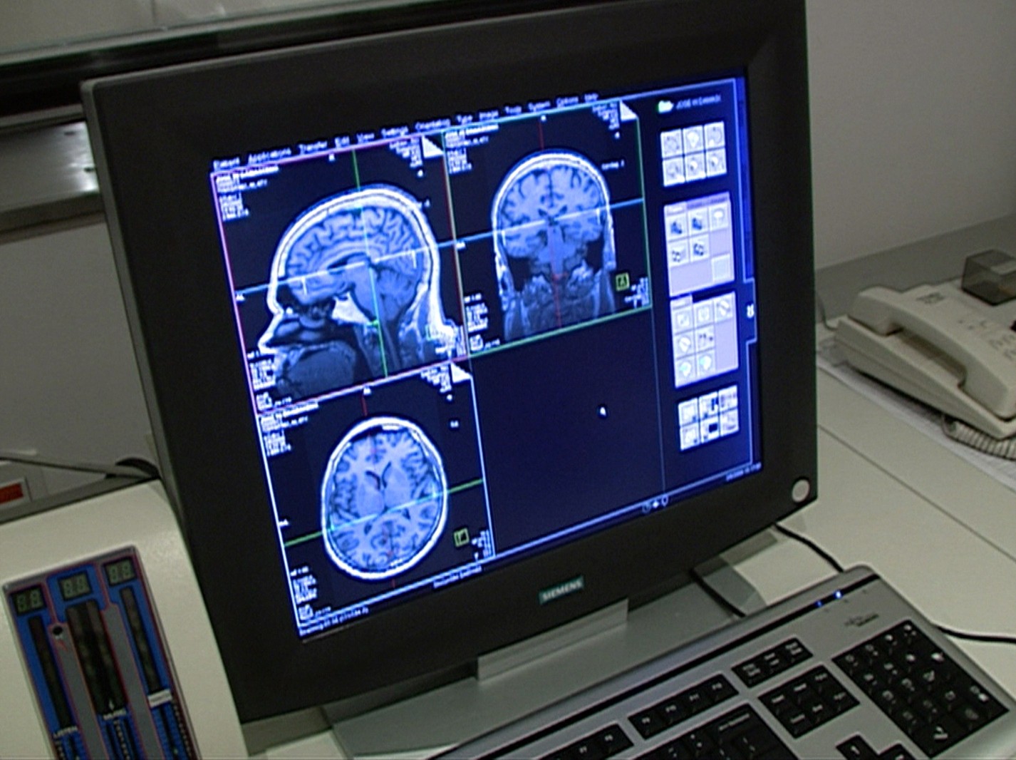 AVC, Alzheimer e enxaqueca: por que OMS emitiu alerta sobre essas doenças e condições neurológicas?
