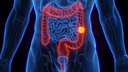 Câncer de intestino: brasileiros reconhecem sinais de alerta, mas não buscam atendimento