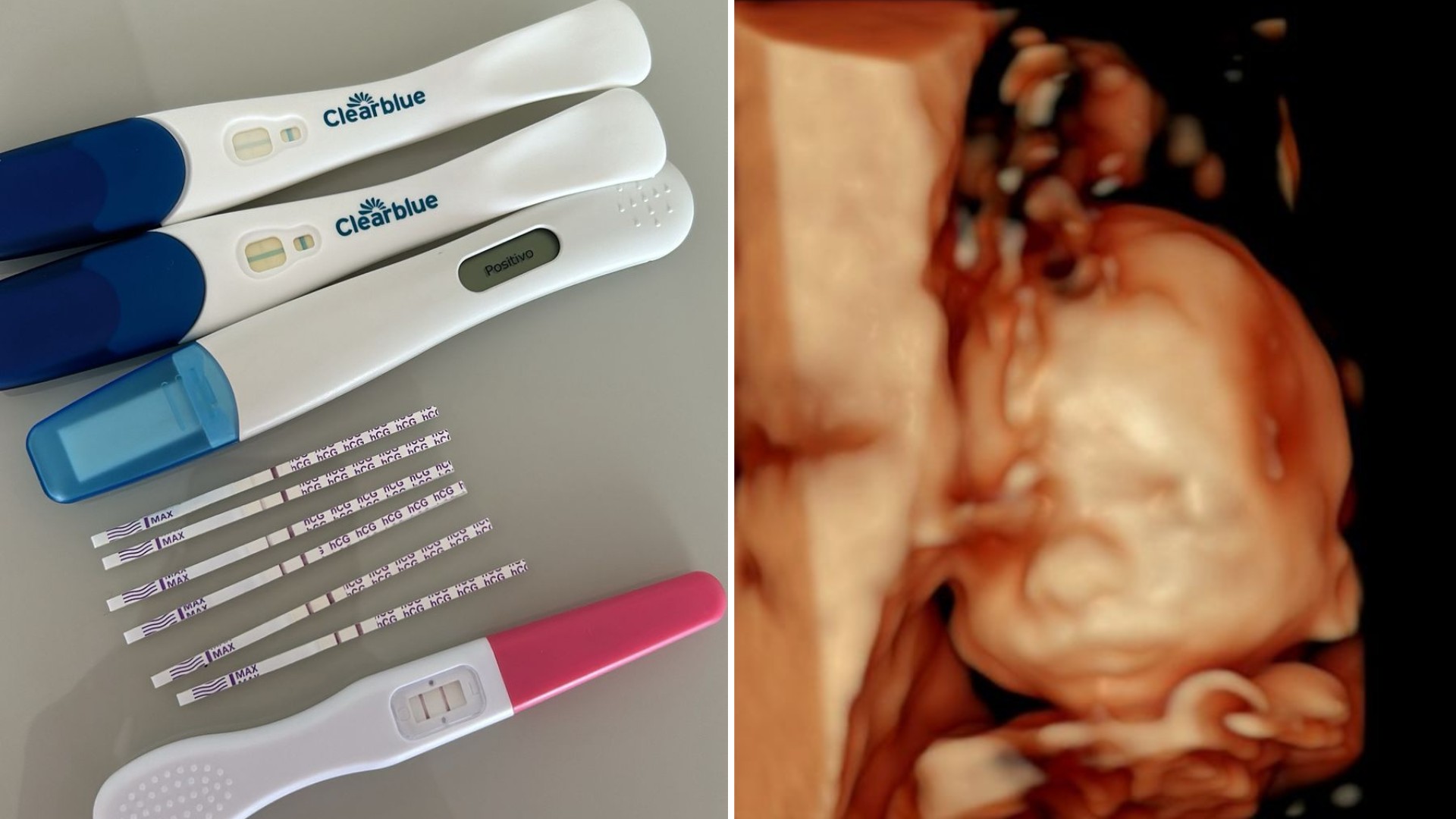'Mães tentantes' lutam por resultado positivo no teste de gravidez após perda do primeiro bebê: 'Sentirei saudades pelo resto da vida'