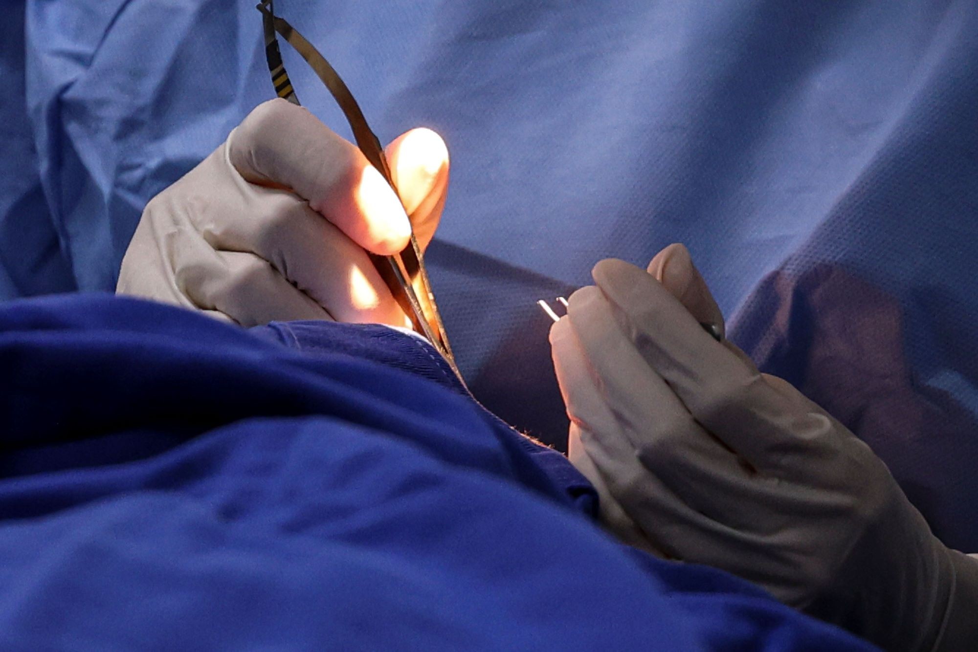 Com 1,4 mil cirurgias em espera, Piracicaba cria tabela SUS para reduzir fila de pacientes; entenda