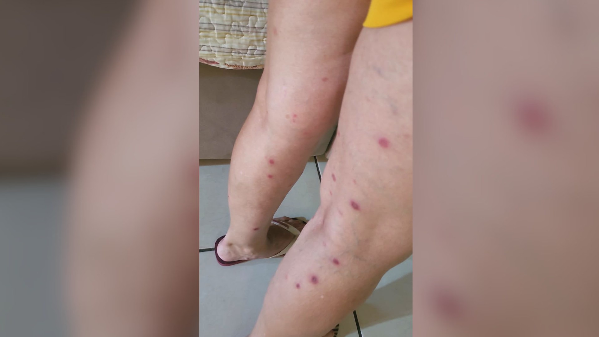 Auxiliar relata coceira intensa e noites sem dormir após surto de sarna humana em creches: 'É insuportável'