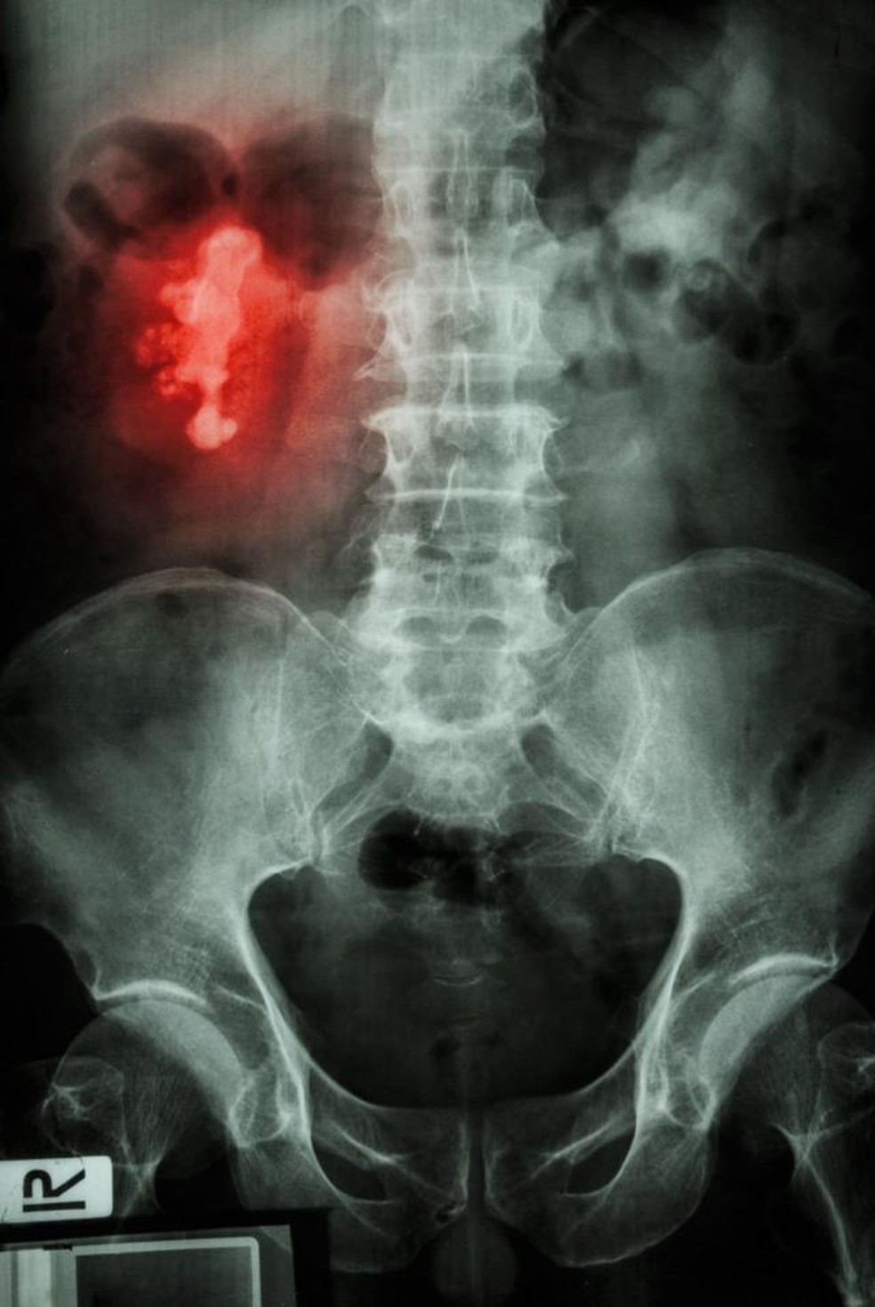 Imagem de raio-x detecta uma pedra chifre de veado no rim direito de paciente. — Foto: GETTY IMAGES via BBC