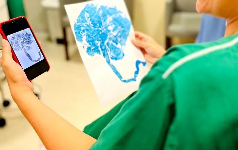Print de placenta registrado na maternidade Ana Bezerra, em Santa Cruz, RN — Foto: Cláudia Michele