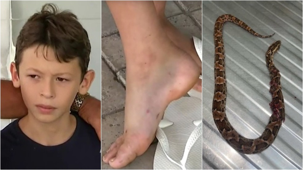 Criança picada por cobra venenosa no Ceará recebe alta — Foto: TV Verdes Mares/Reprodução