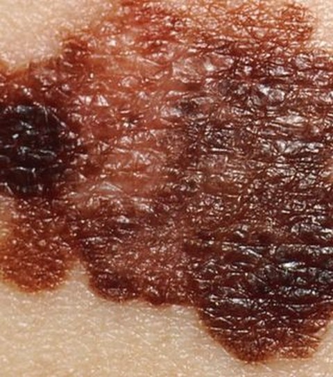 G1 > Ciência e Saúde - NOTÍCIAS - Inverno intensifica doenças de pele
