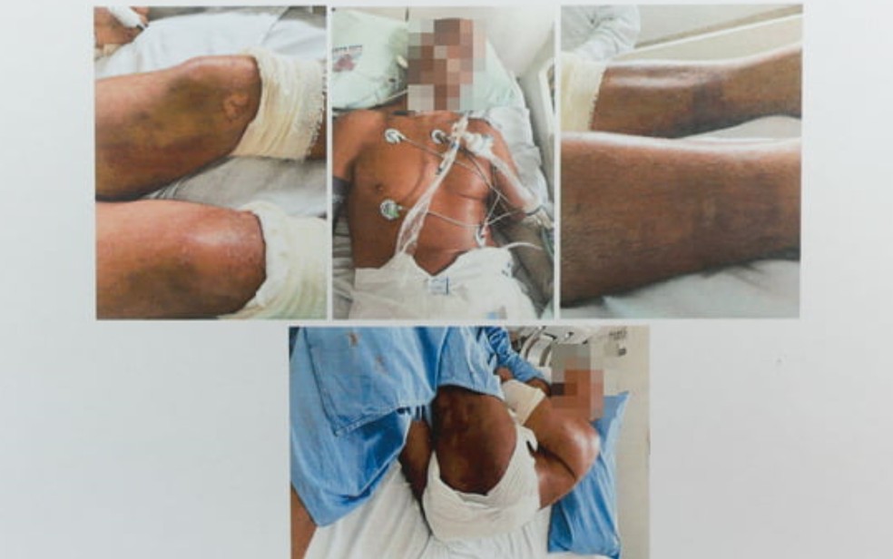 Hematomas no corpo de major da PM após curso do Bope, em Goiás — Foto: Reprodução/MPGO