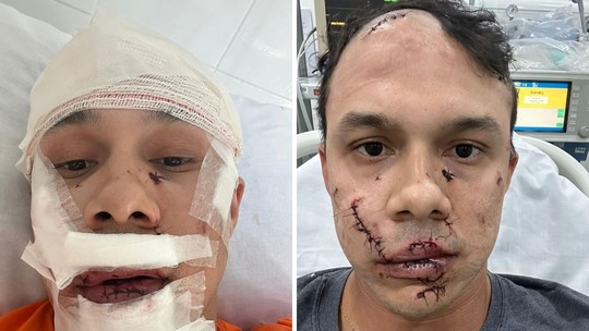 Personal leva 45 pontos no rosto ao defender mulheres e ser agredido em bar