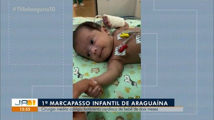 Cirurgia inédita em Araguaína implanta marca-passo em bebê