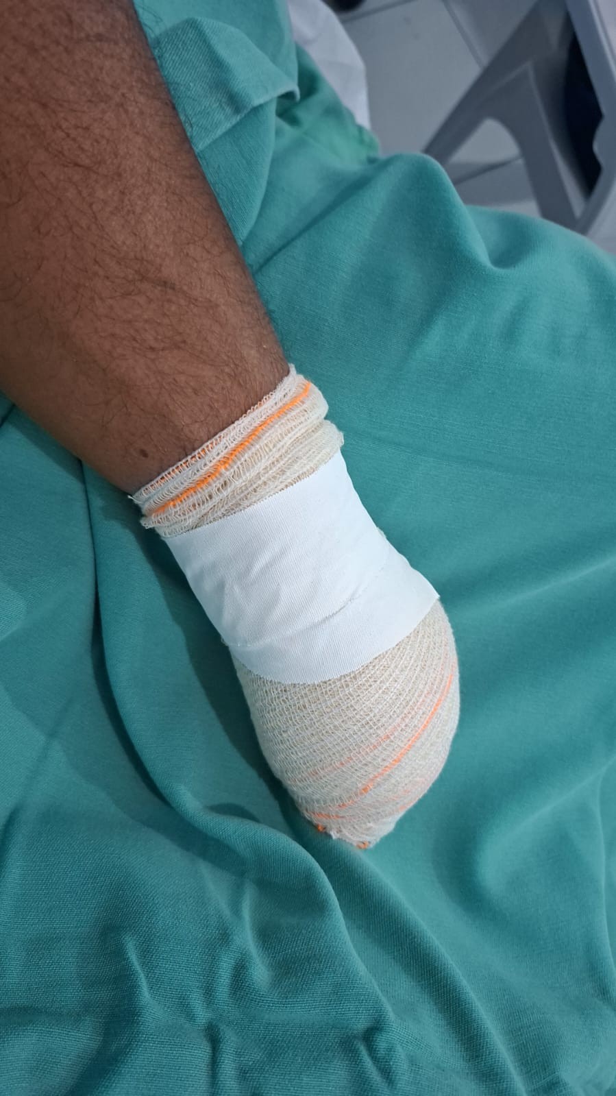 Homem tem a mão decepada após briga por terreno no Norte do Piauí; suspeito é procurado