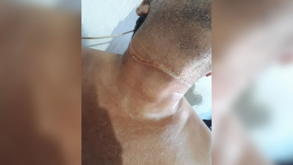 Motociclista é atingido por fio rompido em rua e sofre corte no pescoço em Independência, no Ceará — Foto: TV Verdes Mares/Reprodução