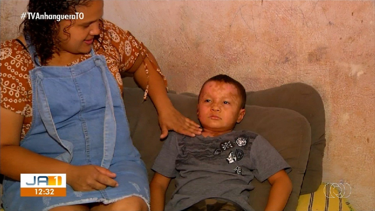 Menino de cinco anos atingido por explosão de churrasqueira recebe alta: ‘Nasceu de novo’, diz mãe