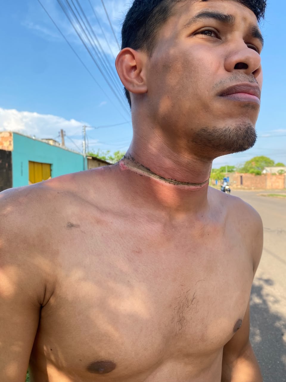 Motociclista fica ferido após fio prender em seu pescoço em Porto Velho