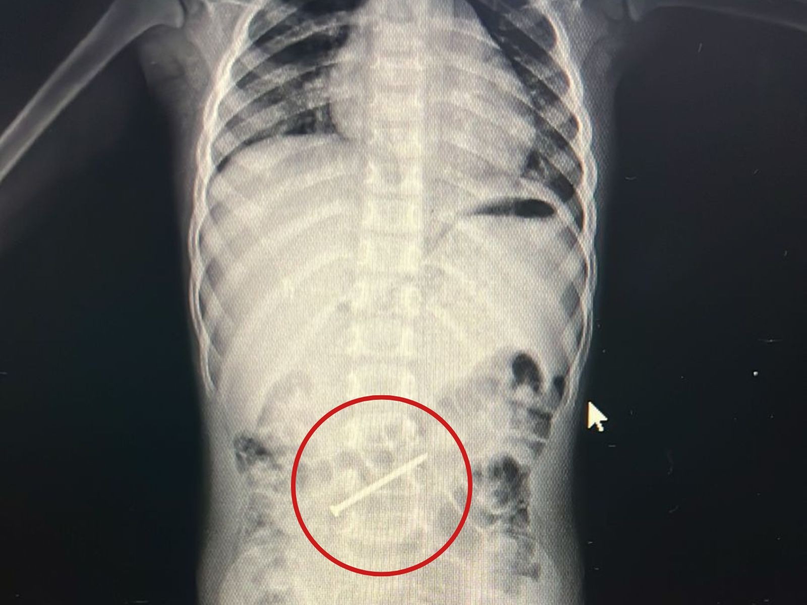 Menino de 3 anos passa por colonoscopia para retirada de prego no intestino no AC