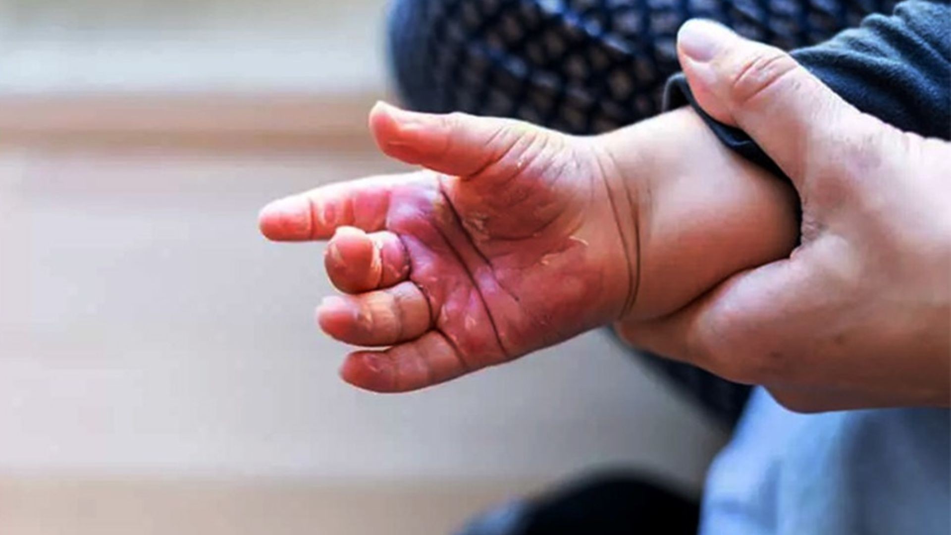 Amapá registra 15 casos de queimaduras em crianças de 1 a 4 anos em 2025; veja orientações