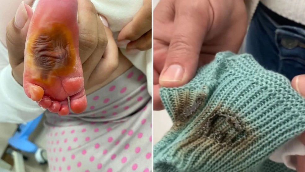 Bebê teve o pé queimado por algodão enquanto estava internado no Hospital Estadual Jayme Santos Neves, na Serra, Espírito Santo — Foto: Reprodução