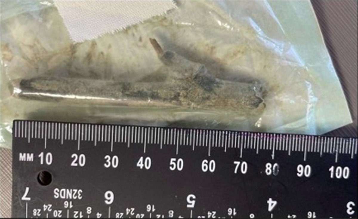 A história do paciente que ficou com pedaço de madeira de 8 cm dentro da perna após erro médico em SC