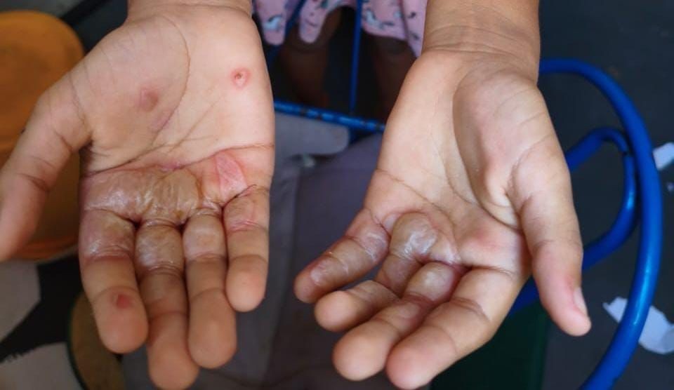 Mulher é presa suspeita de queimar a mão da filha com ovos quentes, em João Pessoa