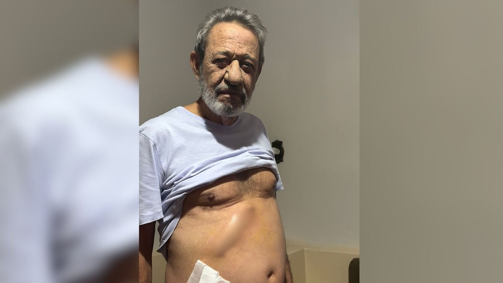 José Aparecido Faria, de 72 anos, mostra cicatriz provocada por cirurgia errada em Birigui (SP) — Foto: Arquivo pessoal