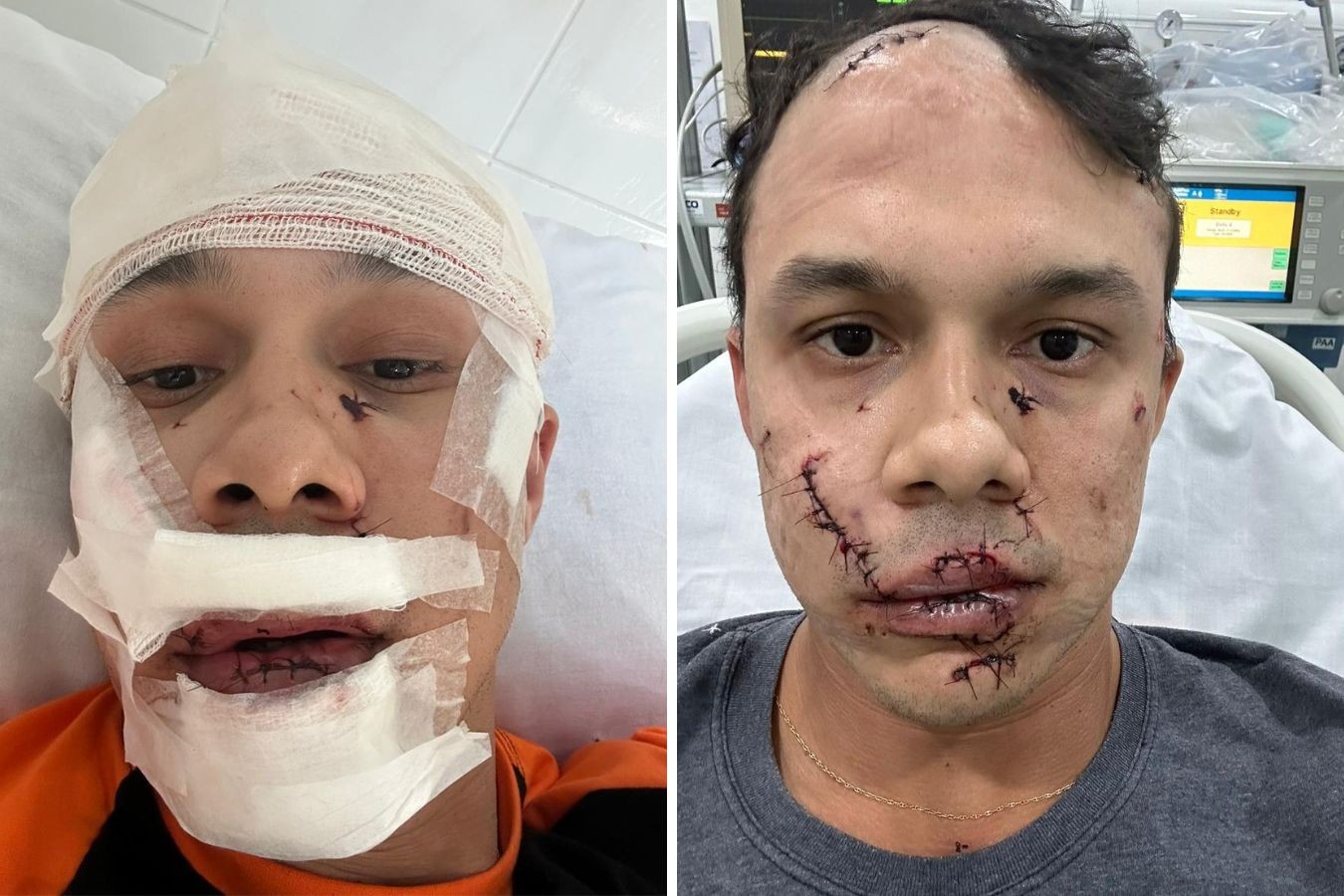 Personal leva 45 pontos no rosto ao defender mulheres de assédio e ser agredido com copo de vidro em bar de SP; VÍDEO