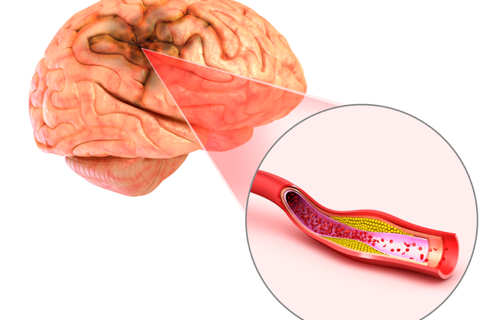 O AVC é causado por uma interrupção do fluxo sanguíneo em parte do cérebro. — Foto: Banco de Imagens