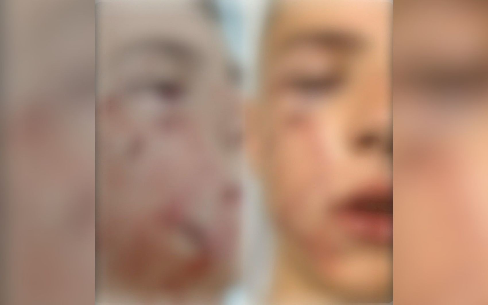 Menino de 10 anos é atacado por pit bull e precisa passar por cirurgia 