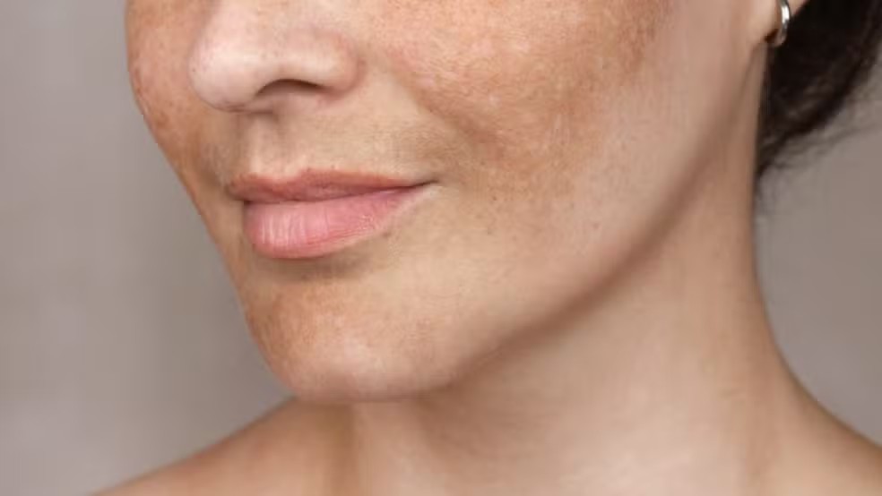 Melasma: novo método ajuda a clarear manchas e prevenir o efeito rebote