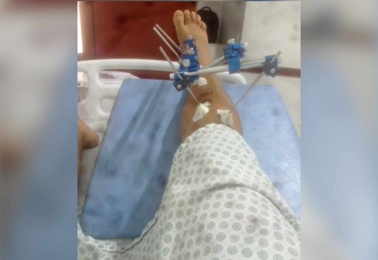 Jovem denuncia ter sido agredido por PMs durante abordagem e dentro de hospital no interior do TO