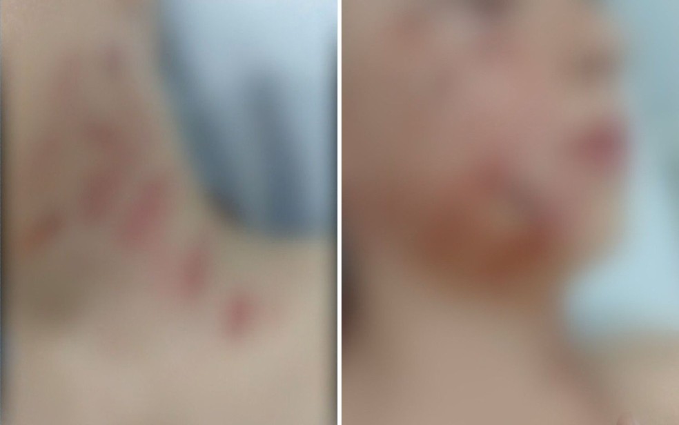 Nicolas teve ferimentos no rosto e pescoço após ataque de pit bull, em Anápolis — Foto: Reprodução/TV Anhanguera