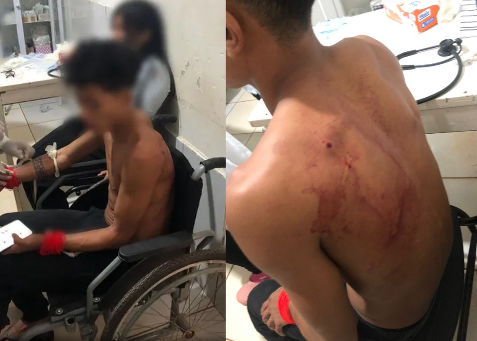 Indígena atingido nas costas recebeu alta e depois foi detido quando ia registrar boletim de ocorrência no Pará  — Foto: Reprodução 