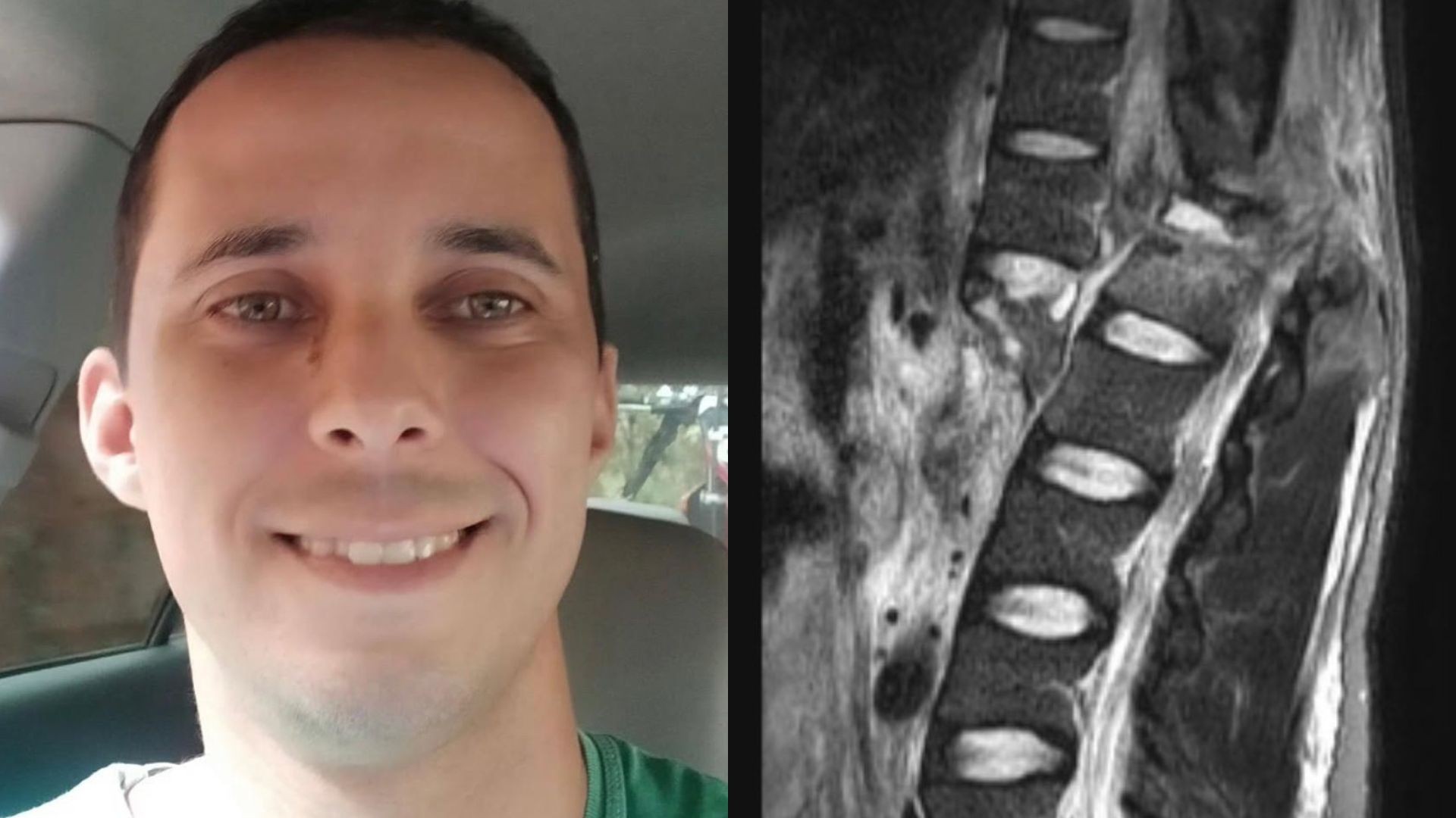 Justiça manda aplicar polilaminina em piloto que sofreu lesão medular grave em competição de motocross no ES