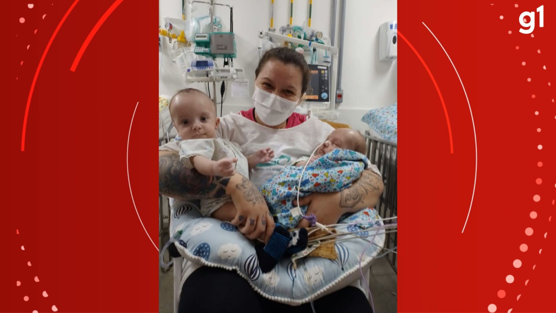 Gêmeos siameses recebem alta após cirurgia de separação no RS; bebês foram adotados