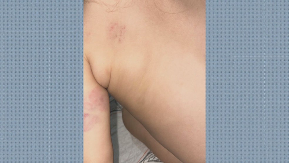 Bebê com marcas pelo corpo — Foto: Reprodução/TV Globo