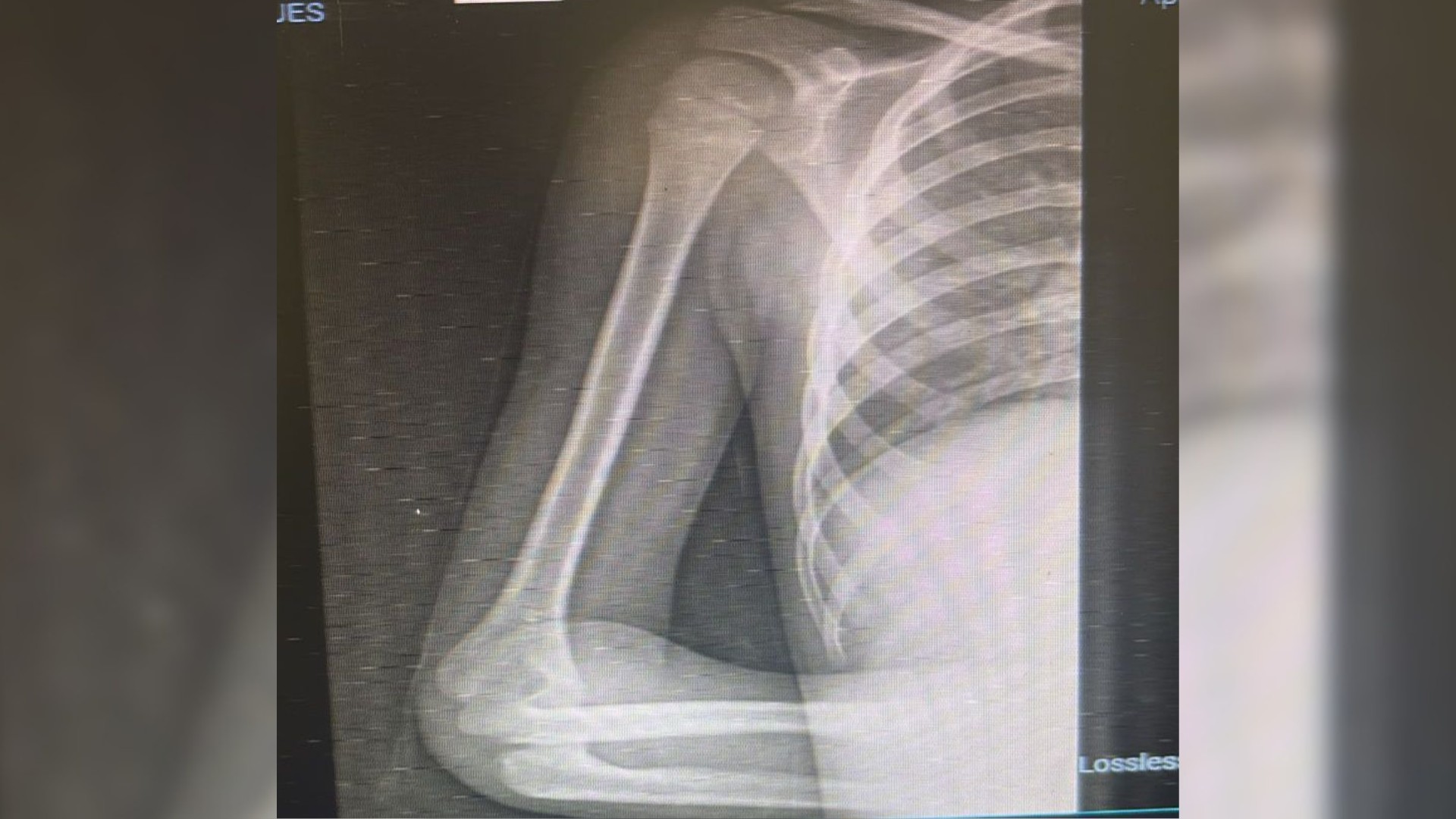 Menino de 6 anos descobre câncer raro após fortes dores no braço: 'Achei que fosse desculpa para não fazer tarefa', diz mãe