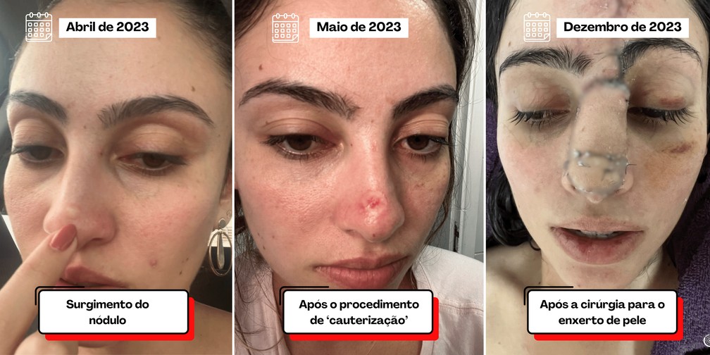 Até o momento, Juliana Vilela já passou por quatro cirurgias para reconstrução do nariz — Foto: Arquivo Pessoal/Montagem g1