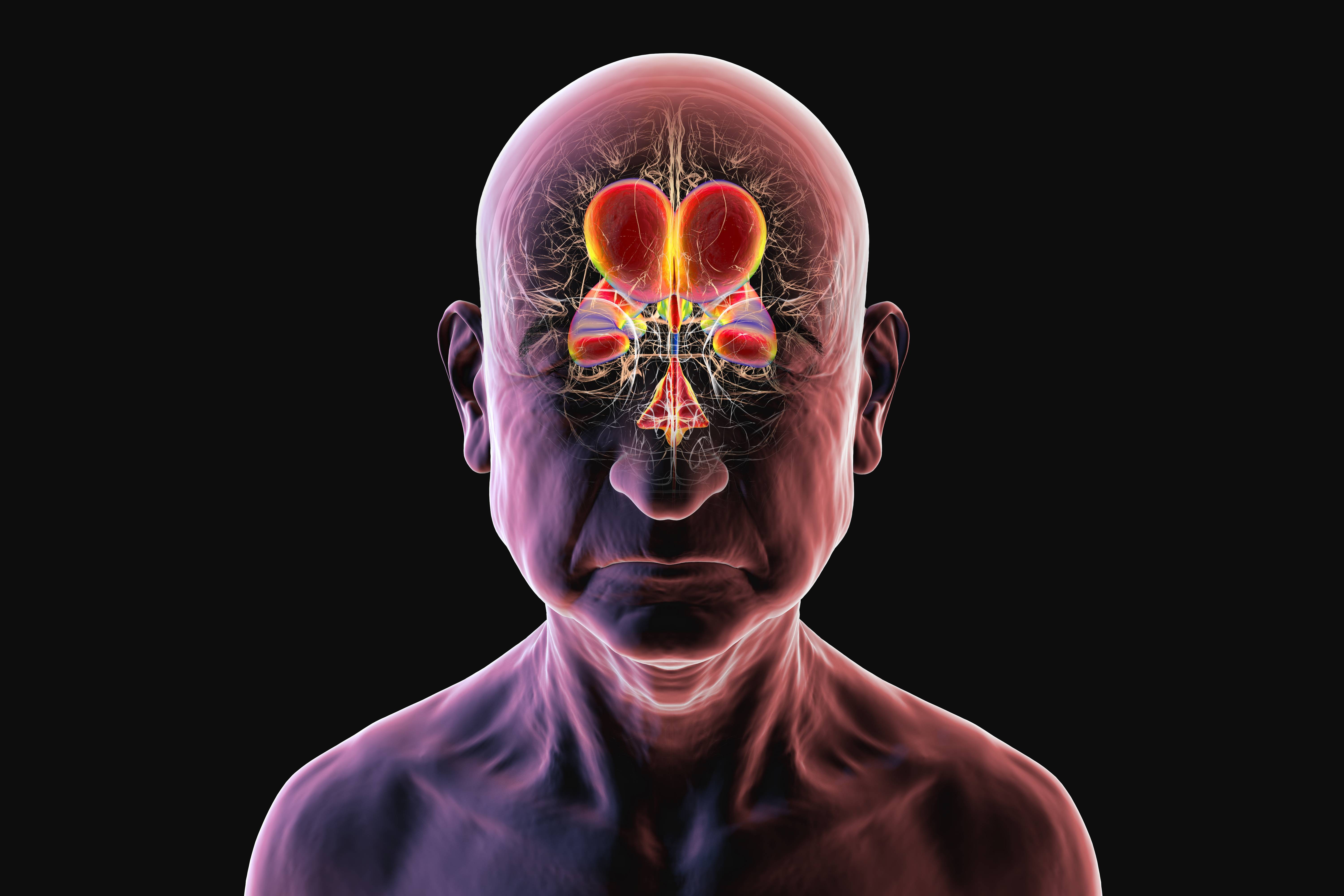 Hidrocefalia de pressão normal (HPN): condição neurológica pode imitar Alzheimer, mas tem chance de reversão