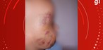 Bebê de 10 meses mordido por colega em escola de Viamão