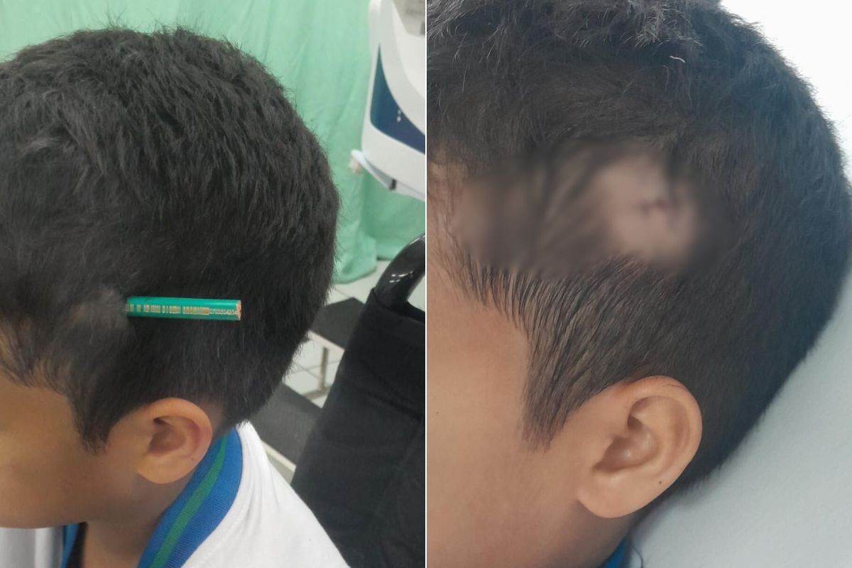 Estudante crava lápis na cabeça de colega após briga dentro de escola no litoral de SP