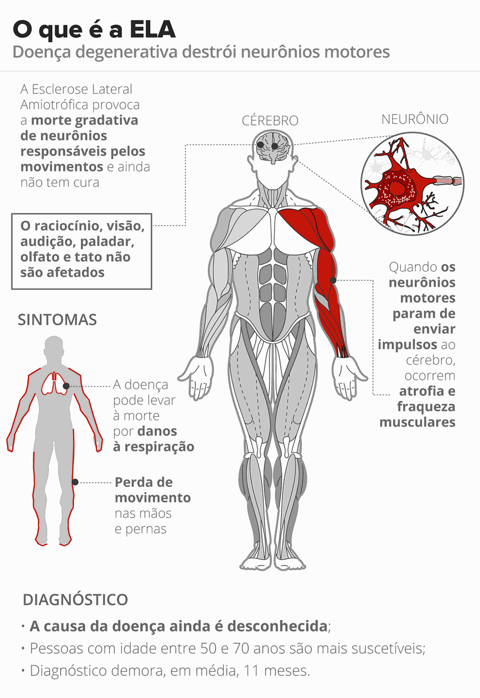 Esclerose Lateral Amiotrófica  — Foto: Infografia: Karina Almeida/G1