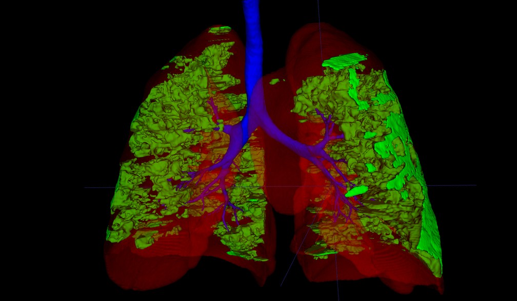 Renderização 3D do pulmão (vermelho) vias aéreas (azul) e regiões acometidas pela Covid (verde) de um paciente, computadas automaticamente pelo método — Foto: Diedre Carmo/Arquivo pessoal
