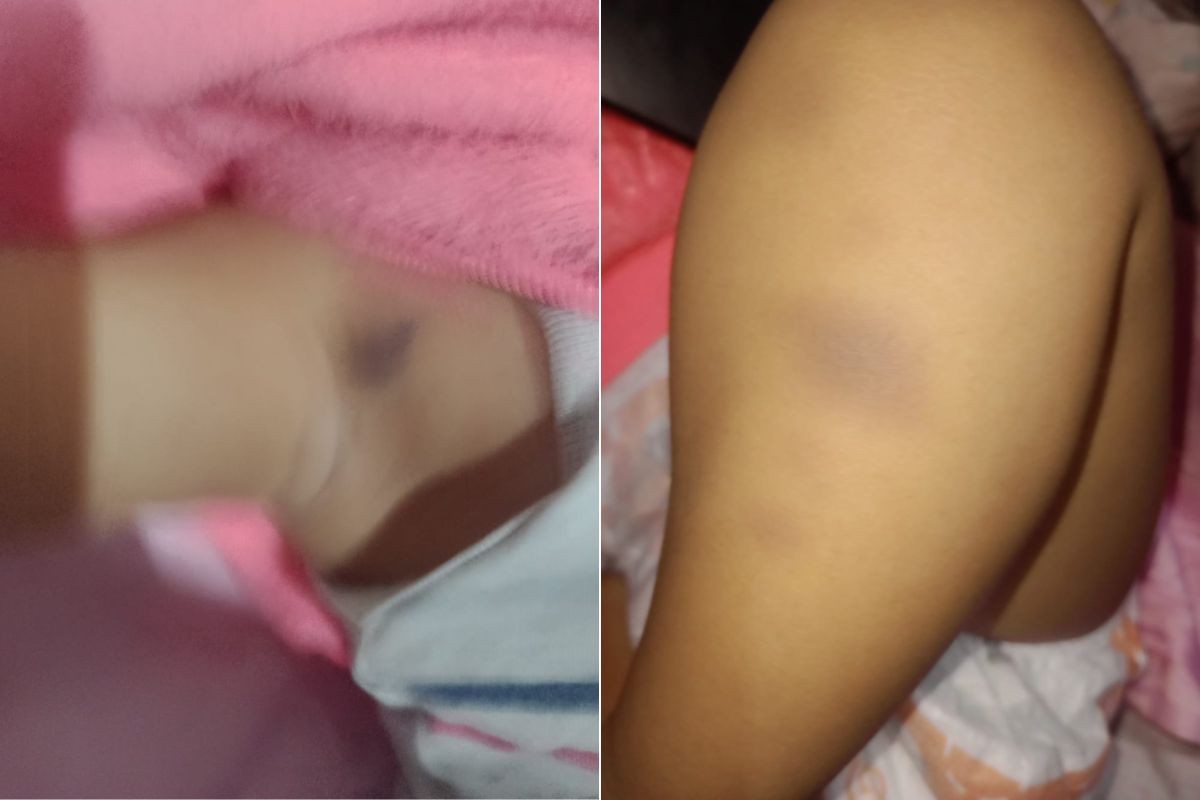 Mãe denuncia agressões após bebê voltar da creche com hematomas no litoral de SP