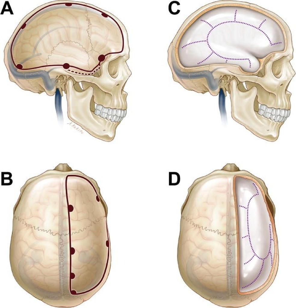 Ilustração mostra como parte da calota craniana é cortada durante o procedimento  — Foto: Reprodução/artigo científico “Wartime decompressive craniectomy: technique and lessons learned”