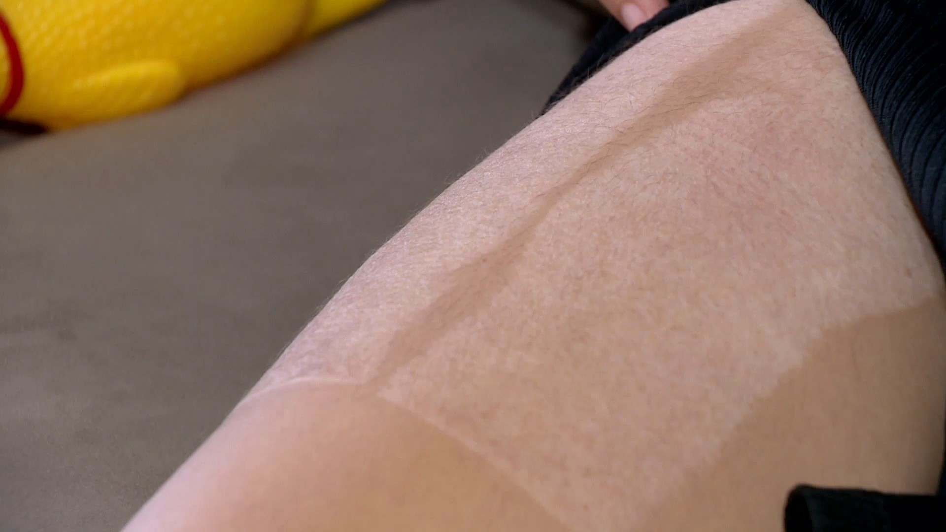 'Meu corpo não vai ser como era': médicos são indiciados após grávida ser queimada durante parto em Colatina