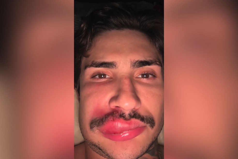 Influenciador de Campo Grande chegou a ser hospitalizado após infecção e alertou os seguidores — Foto: Redes sociais/Reprodução