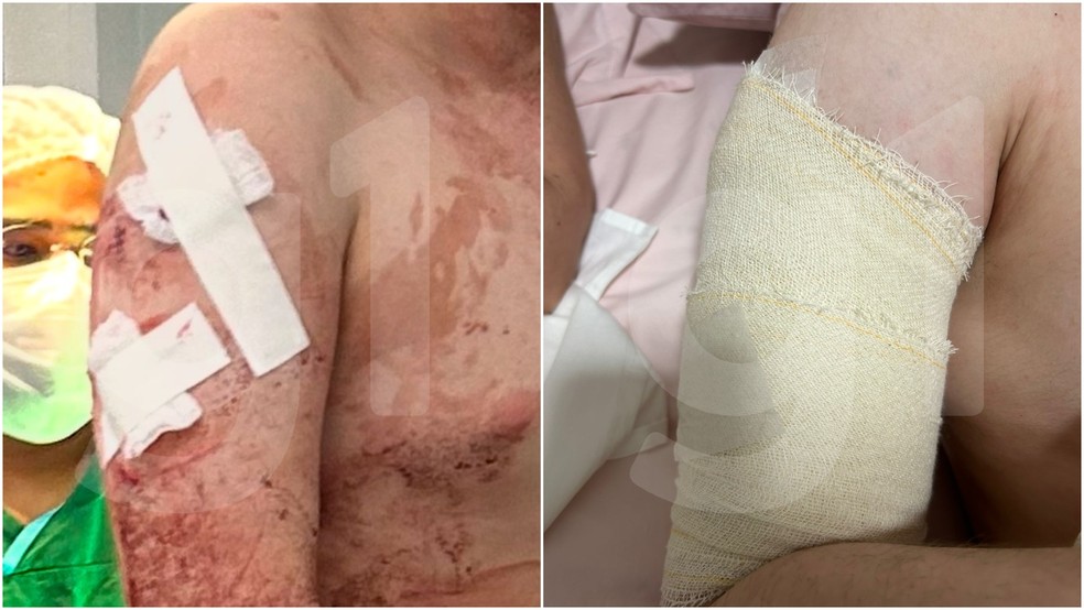 Aluno atacado por outro estudante em escola particular de Fortaleza recebeu alta com 30 pontos pelo corpo. — Foto: Arquivo pessoal