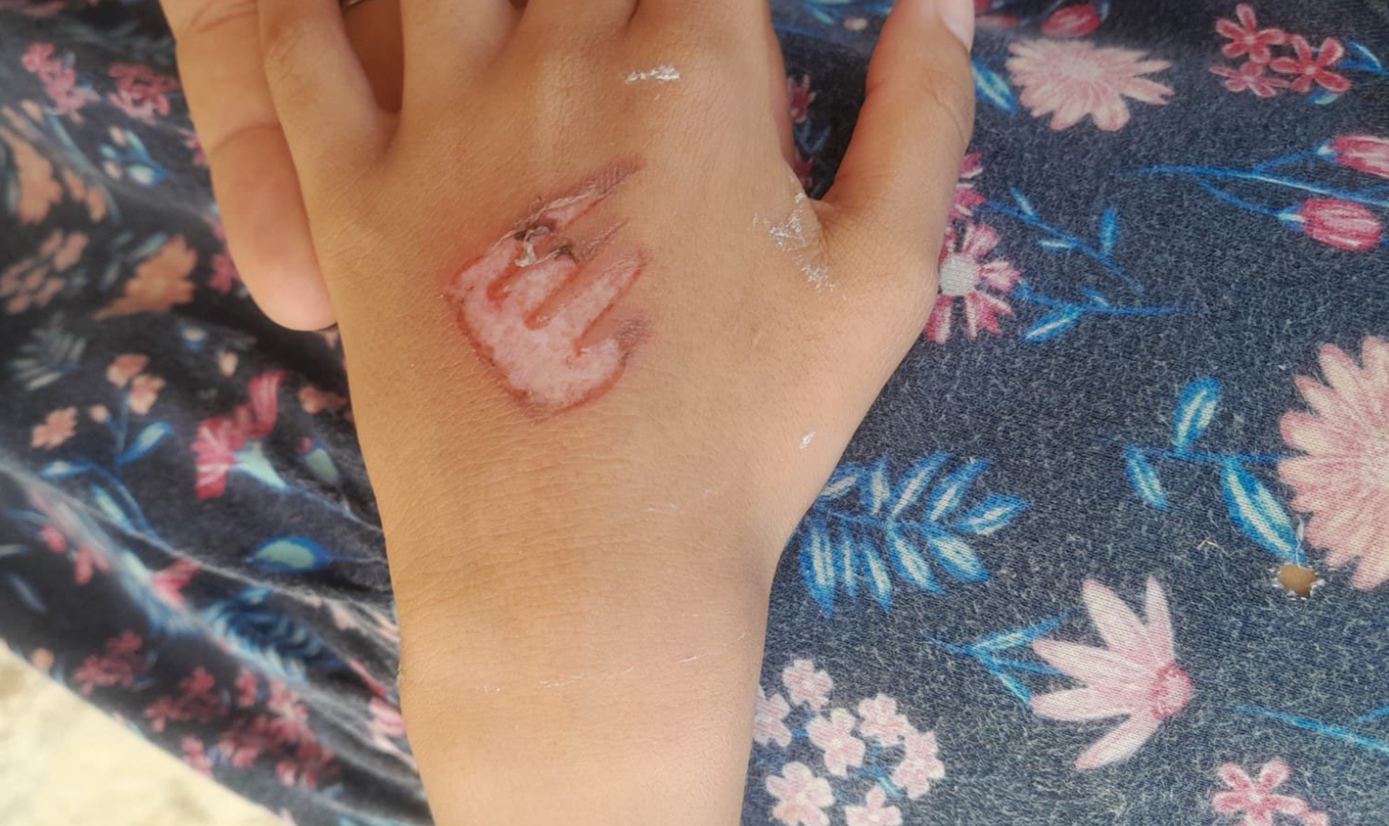 Menina de 7 anos é queimada pela mãe com garfo quente na genitália e na mão