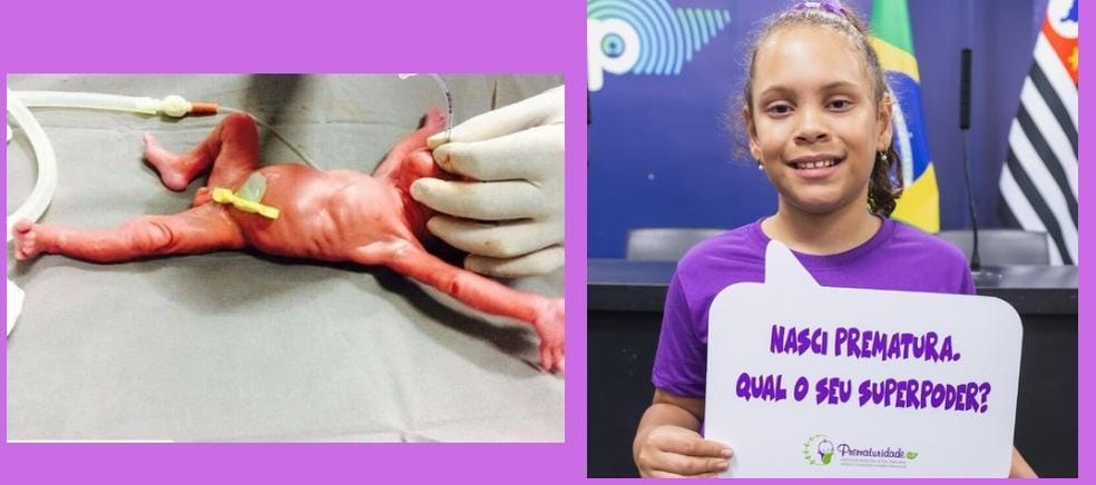 Eva, hoje com 9 anos (à direita), e assim que nasceu, prematura, com 27 semanas (à esquerda) — Foto: Arquivo pessoal