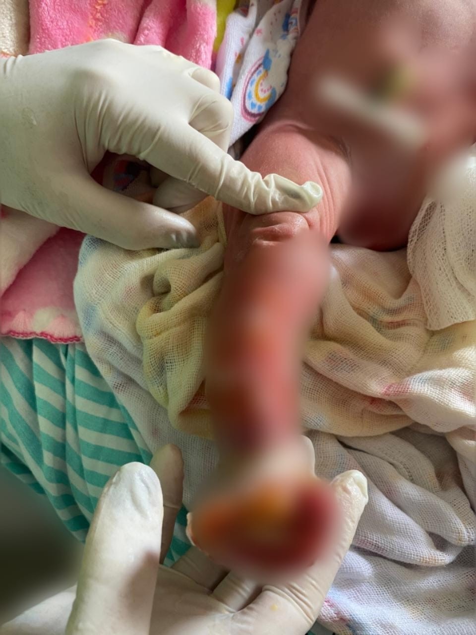Família acusa hospital de causar queimaduras durante banho em recém-nascida no Acre; Saúde investiga