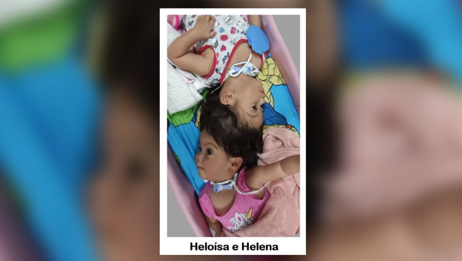 Mãe de gêmeas que nasceram unidas pela cabeça sonha poder carregar filhas no colo após cirurgia em SP