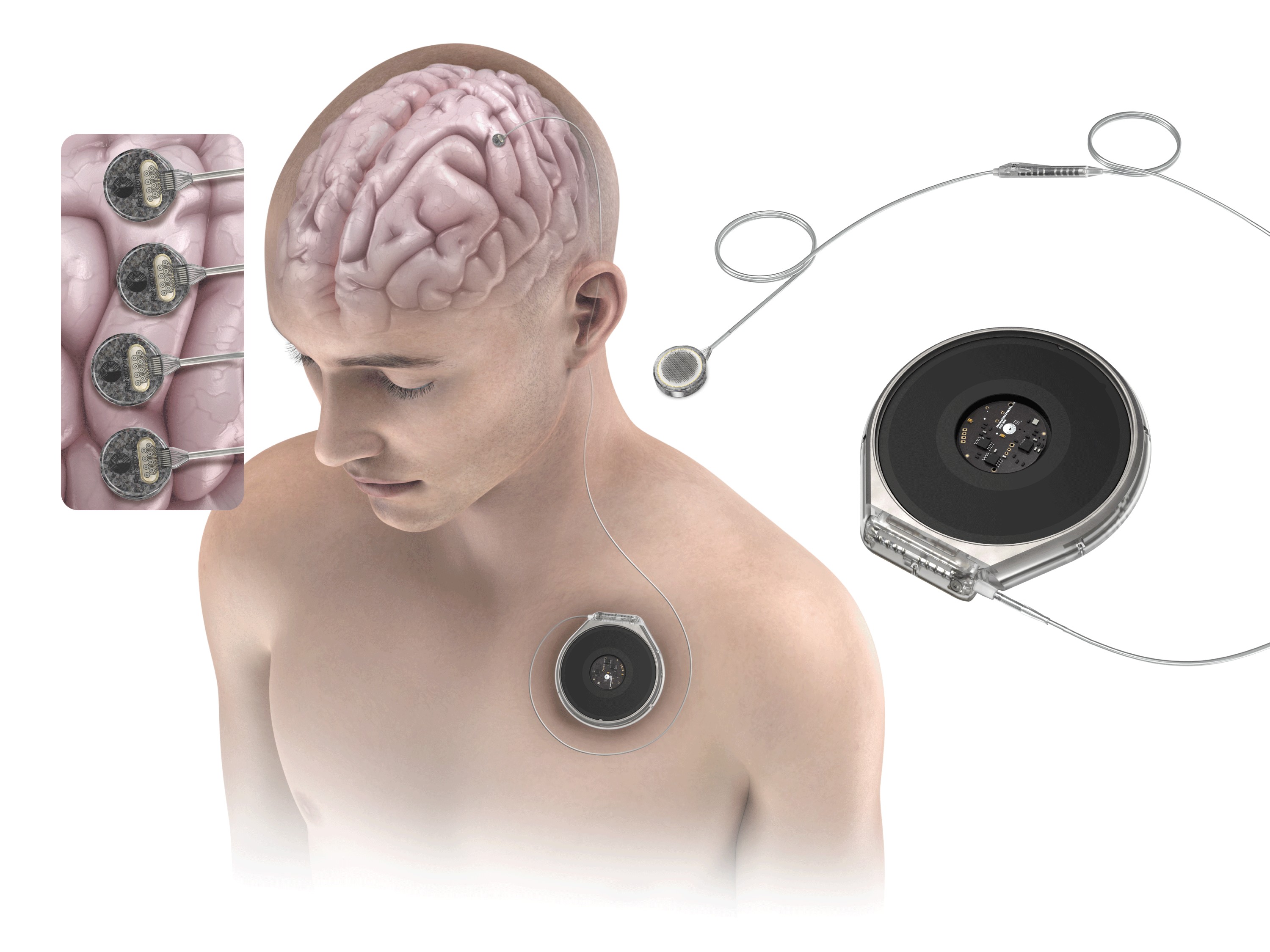 Chip cerebral: empresa rival de Musk testa primeiro implante em humano; veja como foi